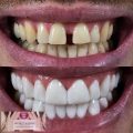 Secret Veneers