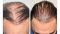 PRP For Hair Loss Great Directions