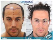 Great Hair Transplants